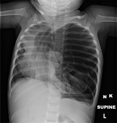 chest xray